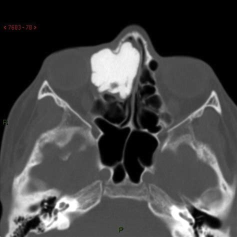 Successful Removal Of Orbito Ethmoidal Osteoma Endoscopically