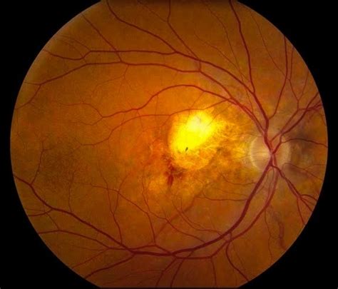 Pseudoxanthoma Elasticum With Cnv Retina Image Bank