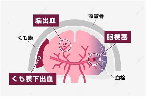 Types Of Human Brain Stroke Vector Illustration Cardiovascular Cerebral