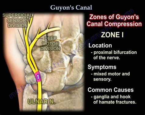 Guyons Canal Ulnar Tunnel Syndrome Everything You Need To Know Dr