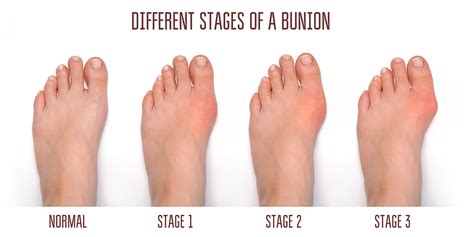 Bunion Surgeon Specialist Nyc Best Bunion Surgeon Brooklyn