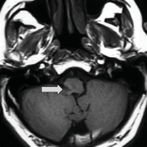 Mri T1 Sequence Showing A Hypointense Lesion Arrow In The Right