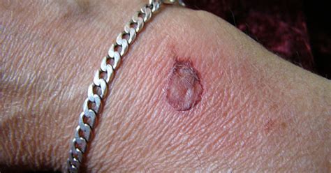 Skin Grafts And Healing Livestrongcom