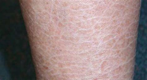Ichthyosis Vulgaris And Diet Is There A Connection Dry Skin Legs
