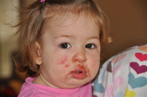 Hand Foot And Mouth Disease Diagnosis And Treatments