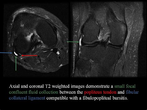 Bursae Of The Knee A Clinical And Radiological Review With An Emphasis