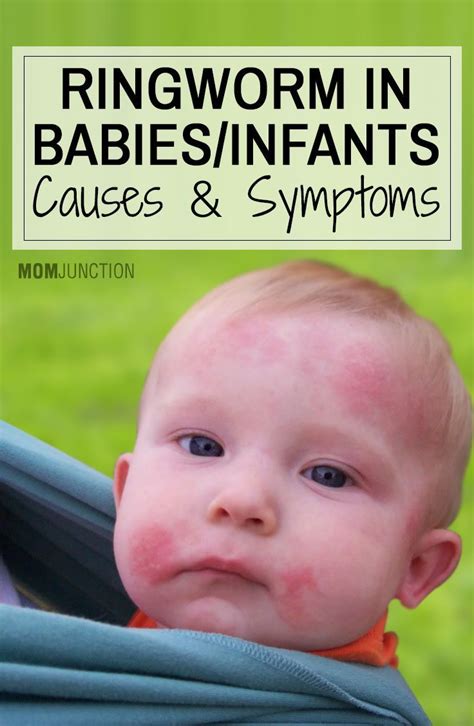 4 Causes Of Ringworm In Babies And 12 Preventive Measures