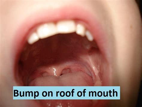 Bump On Roof Of Mouth What Is The Cause 2023
