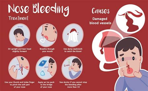 Nosebleeds Epistaxis In Children Causes Risk Factors And How To