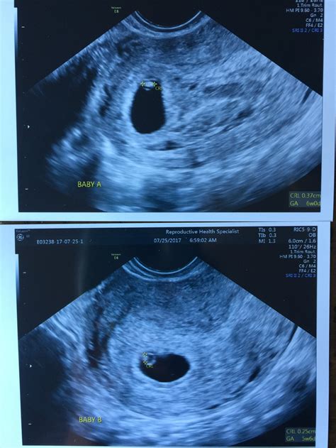 However many mamas of twins report they felt their pregnancy symptoms ramped up a notch at the 6 week mark. 6 week Ultrasound — The Bump
