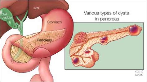 Mayo Clinic Q And A Why Pancreatic Cysts Usually Are Not Worrisome