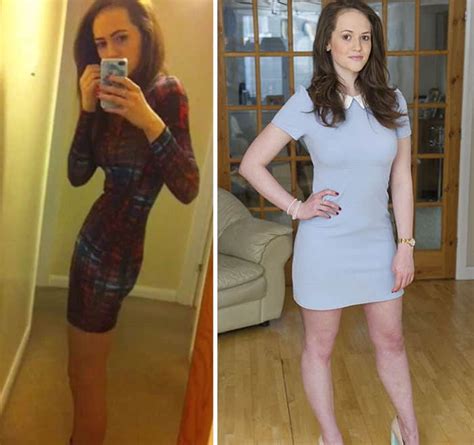 45 ‘before And After Photos Of People Who Beat Anorexia