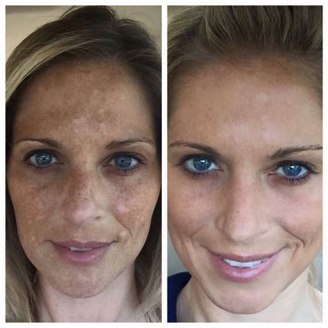 Check Out Jenna Mcpeeks Results Using The Reverse Regimen To Treat