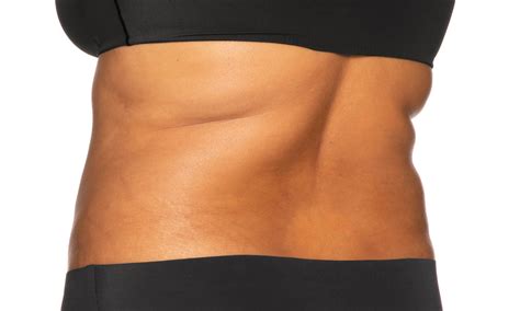 Coolsculpting Elite Treatment In Red Bank Synergy Wellness