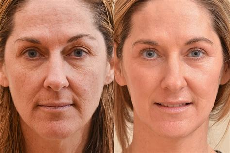 Erbium Laser Under Eyes Before And After