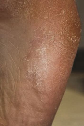 Treatment Principles For Tinea Pedis