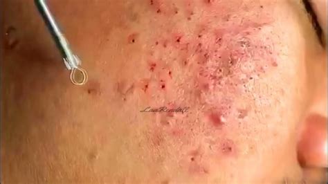 Popping Huge Blackheads And Pimple Popping Best Pimple Popping Videos