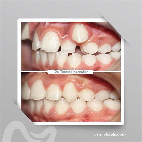 Premolar Extraction Braces Before And After Before And After