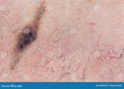 Human Skin With Hematoma Stock Photo Image Of Veins 76500204