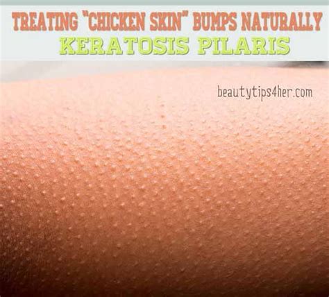 Treating Chicken Skin Bumps Naturally Keratosis Pilaris Trusper