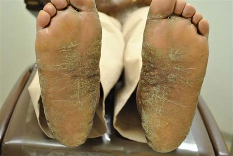 Psoriasis The Foot And Ankle Online Journal