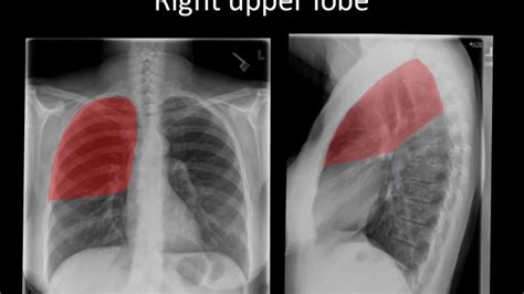 A good radiologist knows the anatomy because knowing where structures normally live and recognizing the location of an abnormality helps to make or narrow the differential diagnosis. Lateral Chest X Ray Anatomy - Anatomy Drawing Diagram