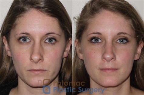 Septoplasty And Rhinoplasty With Turbinate Reduction To Realign And