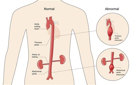 Thoracic Aortic Aneurysm Aortic Dissection Marfan Foundation