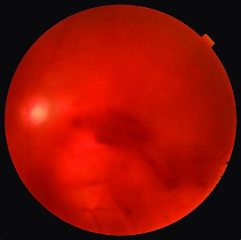 Color Fundus Photograph Showing Suspended Vitreous Hemorrhage
