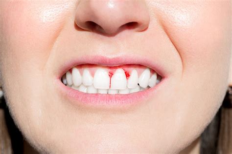10 Reasons Why You Might Be Suffering From Bleeding Gums