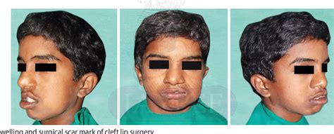 Figure 1 From Multiple Odontogenic Keratocysts In Nonsyndromic Patients