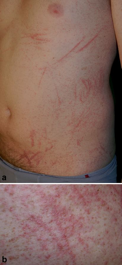 Shiitake Dermatitis Now Also In Poland Html Acta Dermato