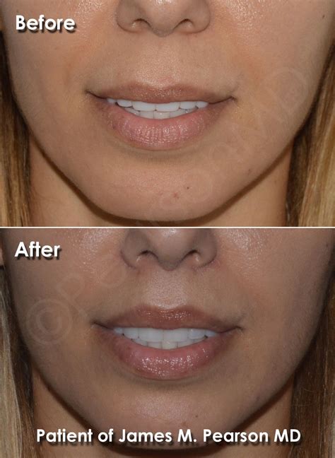 Photo Lip Lift Dr James Pearson Facial Plastic Surgery In 2021 Lip