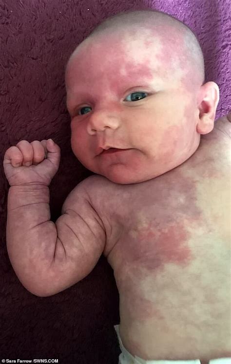 mother of girl born with purple birthmarks hid her from strangers for six weeks after she was