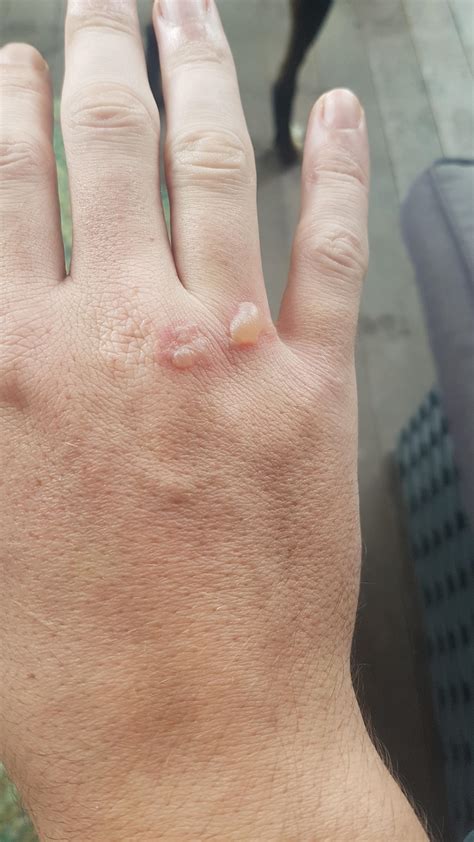 Strange Blisters On My Right Hand Also A Trail Of Red Dots On My