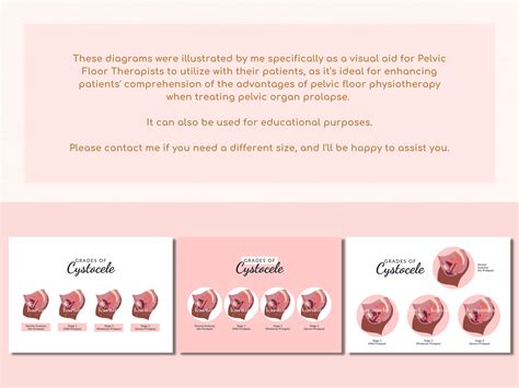 Printable Diagram Of Cystocele Grading Stages Of Cystocele Etsy UK
