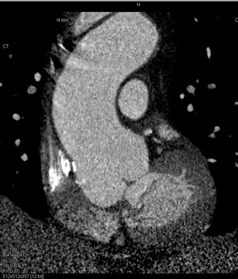 Calcified Bicuspid Aortic Valve With Dilated Ascending Aorta Cardiac
