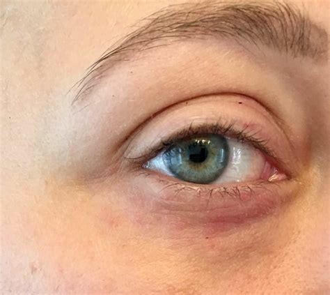 What Is This Rash Under My Eye And How Can I Get Rid Of It