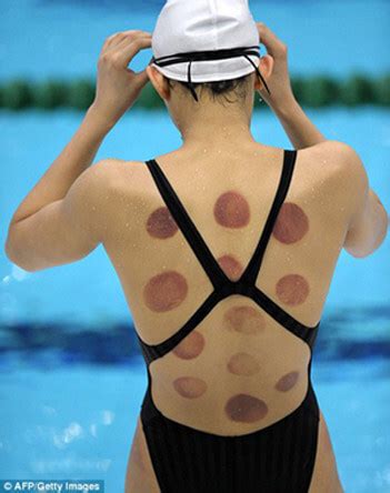 A Look Back When Cupping Therapy And Those Purple Bruises Became A Curiosity