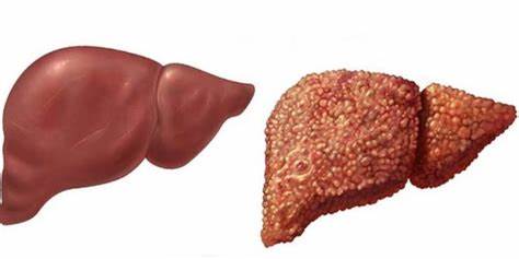 Фиброз печени 1 степени диета