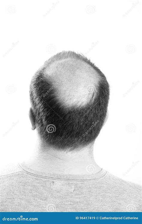 Baldness Alopecia Man Hair Loss Isolated Royalty Free Stock Photography