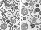 Pathogenetic basis of Takenouchi-Kosaki syndrome: Electron microscopy ...