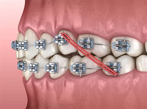 Orthodontic Elastics Orthodontist In Glastonbury Ct