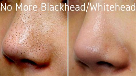 Best Blackheadwhitehead Treatment How To Remove Blackhead Hiphop