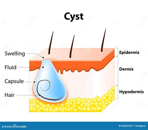 Cyst Stock Vector Illustration Of Gland Dermatology 64632354