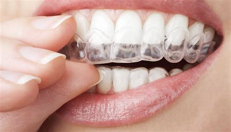 Is Invisalign Right For You Tooth Fairy Dental Mt Maunganui And Te Puke