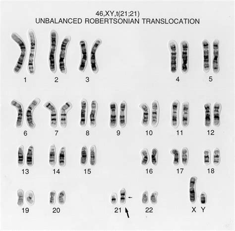 Unbalanced Translocation 46 Xy T 21 21 Wellcome Collection