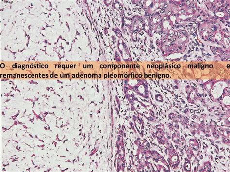 Carcinoma Ex Adenoma Pleomorfico