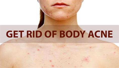 How To Get Rid Of Body Acne