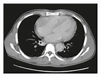 (a–c) CT imaging of the chest without contrast. The heart is normal in ...